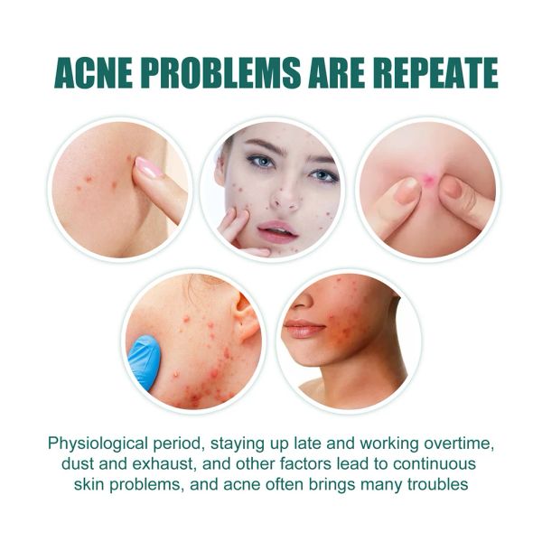 112pcs Pimple Acne Concealer Beauty Acne Tools Star Shaped Hydrocolloid Acne Patches Cute Pimple Spot Bandages for Face Healing